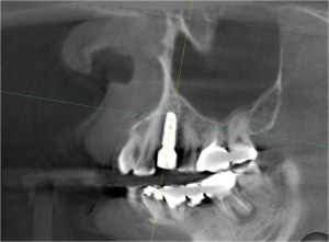 Dental X-Ray