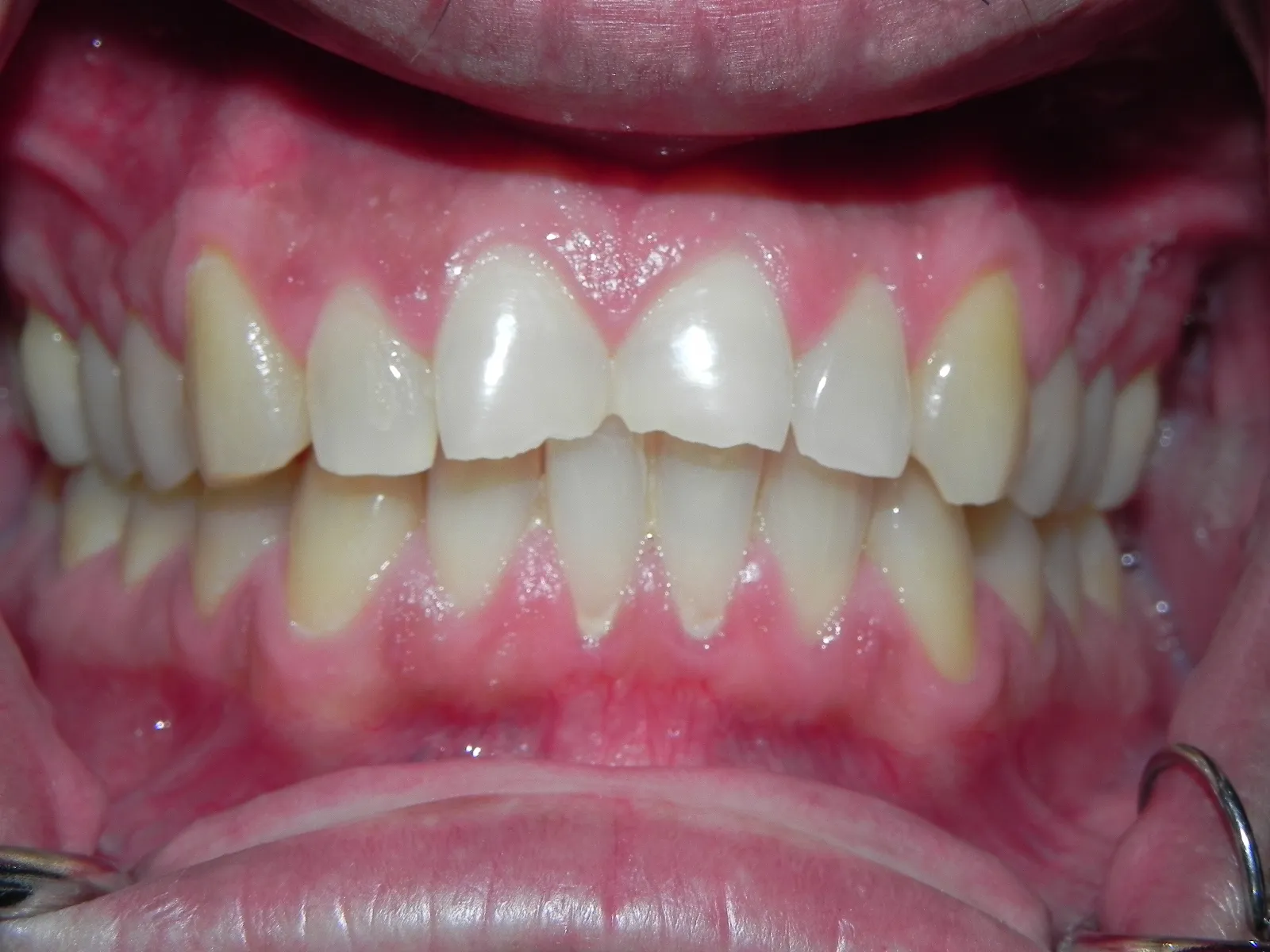 Close up image of teeth before dental work showing chipped, uneven teeth