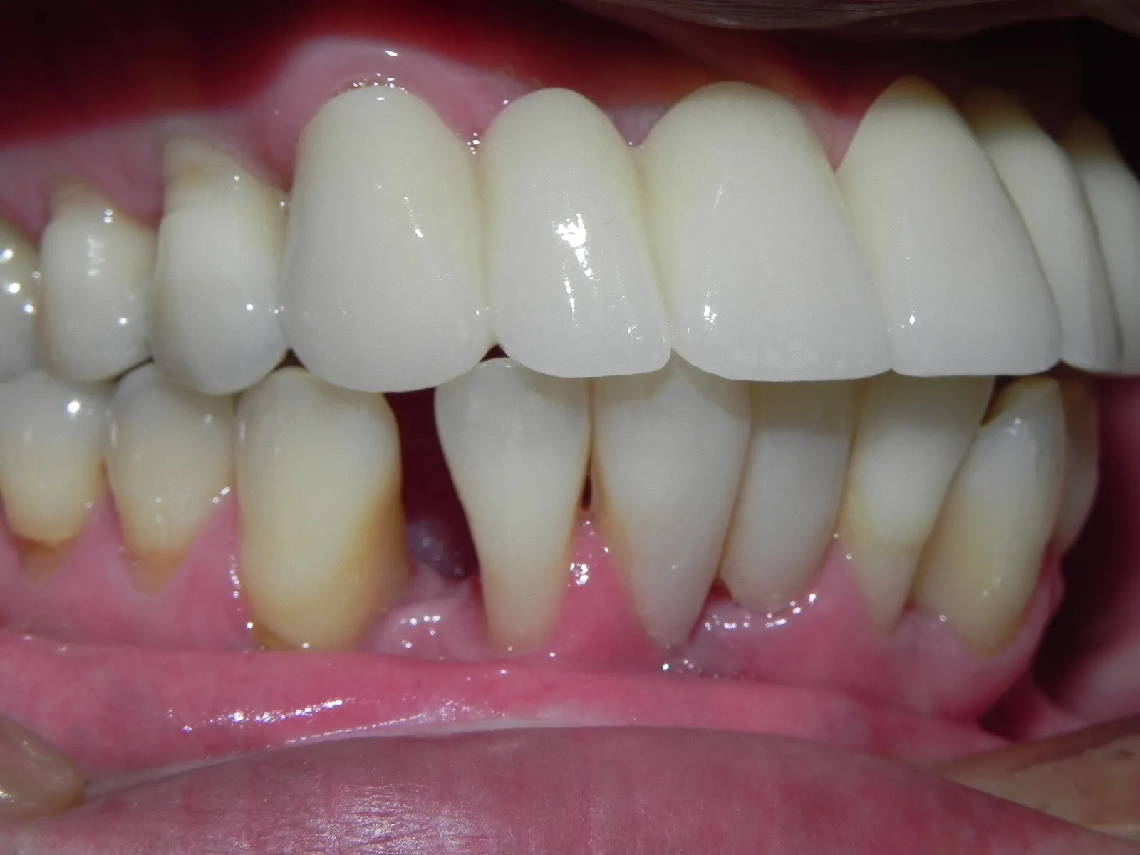 Close up of bottom teeth showing large gap between two teeth