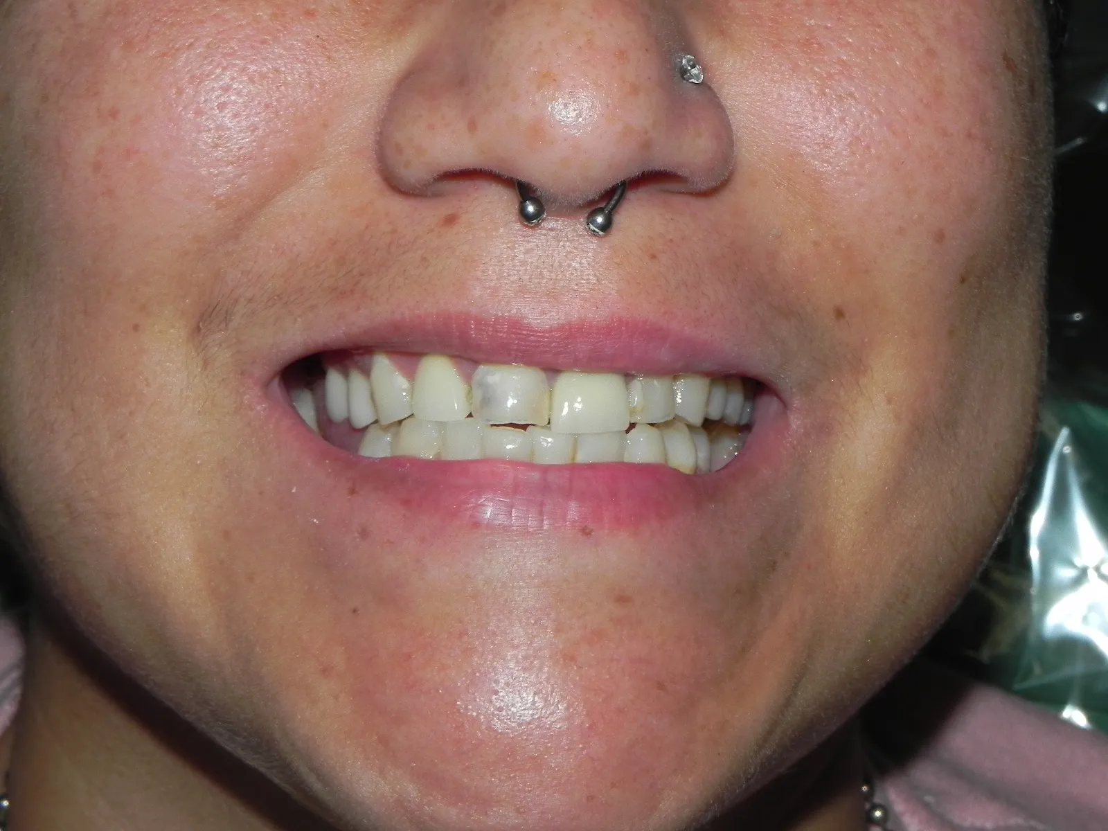 Close up of teeth before dental filling showing damaged, darkened tooth